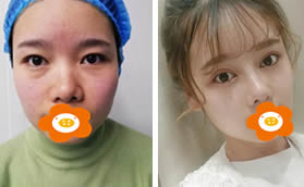 來瞅瞅我在鄭州菲林整形雙眼皮隆鼻一起做的恢復(fù)經(jīng)歷