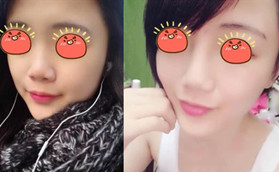 金華金東區(qū)令顏醫(yī)療美容門診部玻尿酸隆鼻前后對比