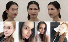 廣州懿美秀整形醫(yī)院自體脂肪填充案例前后對(duì)比照