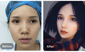 南京檸檬醫(yī)療美容朱曉波鼻綜合案例