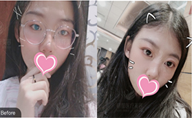 北京米蘭柏羽麗都曹衛(wèi)華做雙眼皮效果怎么樣？埋線雙眼皮真人案例