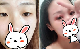 做雙眼皮一定要開眼角嗎？反正我到常州美貝爾面診是做了