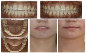 沈女士分享在廊坊圣潔口腔做牙齒矯正