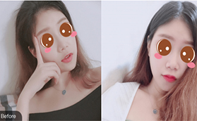 北京豐唇哪家好？記錄在北京葉子玻尿酸豐唇十天恢復(fù)情況