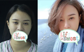 桂林星范整形葉向東威寧假體+耳軟骨隆鼻案例效果圖來了