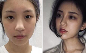 找蘭州皙妍麗醫(yī)療馬振峰醫(yī)生做完鼻部多項后顏值飆升！