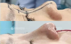 廣州高尚醫(yī)療門診部膨體+耳軟骨隆鼻案例對(duì)比照