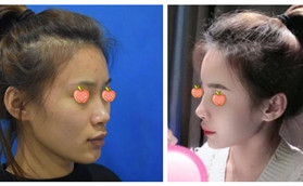 鼻綜合一定要取雙側(cè)耳軟骨嗎?我用單側(cè)耳軟骨隆鼻后高度OK