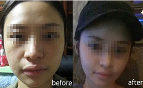 杭州時(shí)光面部自體脂肪填充案例