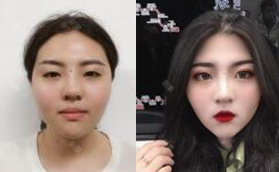 蘭州夢(mèng)想整形醫(yī)院趙梅霞雙眼皮怎么樣？?jī)r(jià)格案例大曝光！