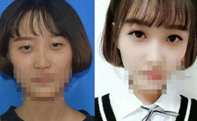 我花2萬多找威海華怡徐茂武做的切開雙眼皮效果你覺得如何?