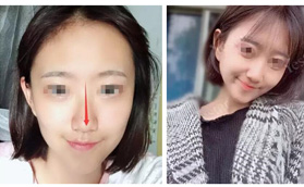 5年隆鼻2次，歪鼻的她終于告別鼻梁低、鼻基底凹陷、鼻骨寬