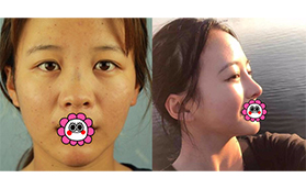 昆明夢想張燕雄肋軟骨隆鼻案例:恢復(fù)后鼻部自然流暢很好看