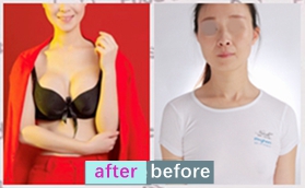 沈陽(yáng)美萊醫(yī)院高國(guó)林傲若拉閃耀女王胸對(duì)比案例