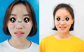 30歲的我牙齒不齊下巴后縮在廈門登特口腔竟然矯正好了