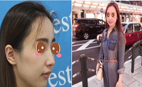 北京去斑需要多錢？北京藝星蜂巢皮秒去斑真人案例供參考