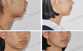 廣州圣貝口腔深覆蓋牙齒矯正案例前后對(duì)比照