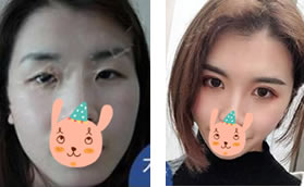 我找廣元美華醫(yī)院楊林院長去眼袋和割雙眼皮后,感覺換臉了!