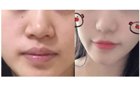 體驗張家界依萊美鼻頭整形技術(shù)，精致的鼻子你也可以有