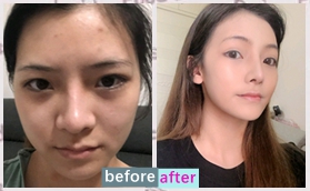 韓緣聚美醫(yī)療美容彭云飛明星線脂肪膠填充案例