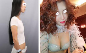 深圳陽(yáng)光是正規(guī)醫(yī)院，在這做的傲諾拉假體隆胸性?xún)r(jià)比很高