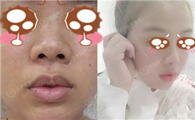 佛系少女在張家界瑞美做鼻綜后改變好大