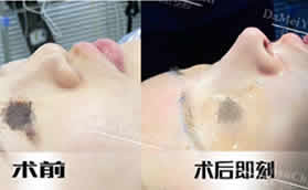 大連達(dá)美元辰隆鼻整形手術(shù)前后對(duì)比效果圖