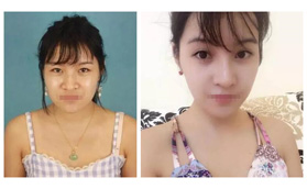 做完雙眼皮的我還繼續(xù)預(yù)約了寧波薇琳的假體隆鼻+注射美容