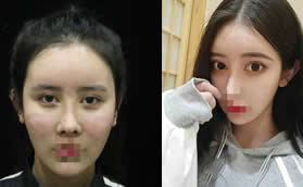 我面部脂肪填充過量失敗去鄭荃麗格做抽吸修復(fù)才恢復(fù)原貌