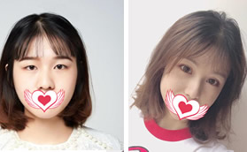 我在鄭州集美割雙眼皮找的是劉德輝,平行型眼睛看著很自然