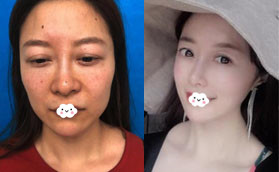 感覺深圳容術(shù)面部脂肪填充價格合理，做了科爾曼脂肪填充