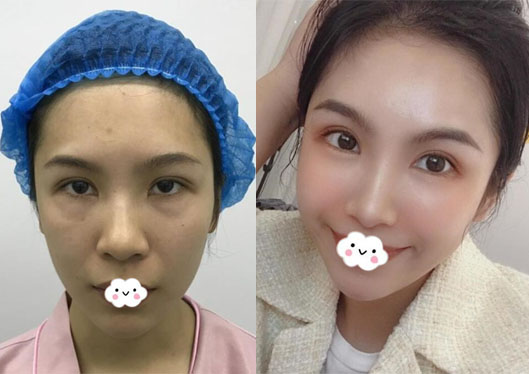 深圳貝漾美天曹思佳雙眼皮修復(fù)+祛眼袋效果與價(jià)格成正比