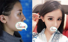 我在美麗焦點(diǎn)做過(guò)鼻子,分享焦俊光院長(zhǎng)焦式隆鼻照片及價(jià)格