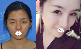 我找深圳春天醫(yī)院楊淑云割雙眼皮時還開內(nèi)眼角和外眼角了