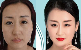 蘭州姜醫(yī)生整形姜春仁院長(zhǎng)的面部脂肪填充案例-讓童顏再現(xiàn)