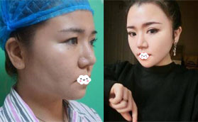 千萬別做光纖吸脂？我找深圳美芮王權(quán)做面部吸脂半年變化