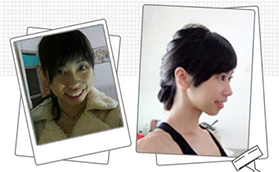 青島維樂口腔醫(yī)院楊春犁半隱形陶瓷矯正案例