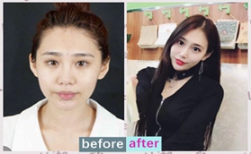 沈陽(yáng)創(chuàng)美薈邊志超眶隔脂肪釋放祛眼袋案例