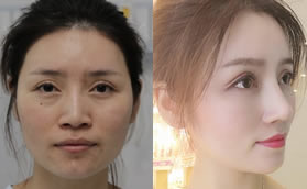 我的肋骨鼻和全臉脂肪填充經(jīng)歷:看衡陽美萊鄧穎技術(shù)怎么樣?