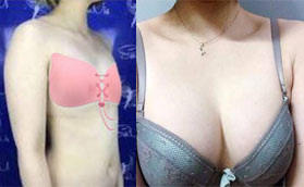 都說深圳藝星朱輝雙眼皮手術(shù)好，我做曼托假體隆胸也很棒