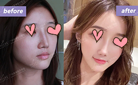 廣州美萊醫(yī)療美容整形醫(yī)院異體骨鼻修復案例