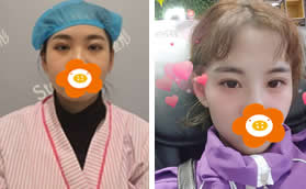 在鄭州辰星做切開雙眼皮+去皮去脂3個(gè)月弧度寬度我都很滿意