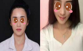 北京沃爾劉彥軍正規(guī)靠譜嗎？馮雁平自體軟骨鼻綜合效果圖