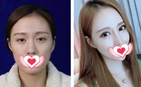 鄭州顏圖麗人黃普利給我做雙眼皮隆鼻手術(shù)后輕松get高顏值