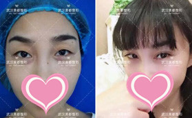 武漢美都整形張浩醫(yī)生給我做的雙眼皮價格不貴還很自然