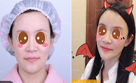 花費(fèi)三萬(wàn)多在北京藝美找王東做自體脂肪面部填充失敗修復(fù)