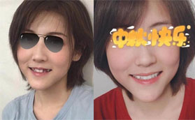 趁價格優(yōu)惠在深圳世紀(jì)河山口腔做了6顆韓國美格真種植牙