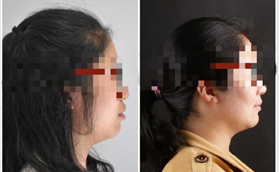 牙槽骨前突的我，在南京美奧口腔牙齒正畸后的對比效果圖