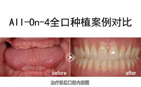 良心醫(yī)生不建議種植牙？我在深圳做All-On-4全口種植牙的感受