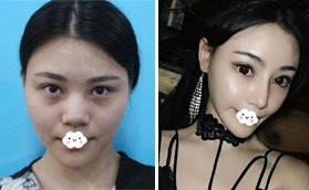 深圳麗港麗格謝俊擅長鼻修復 選這正規(guī)醫(yī)院做了鼻綜合隆鼻